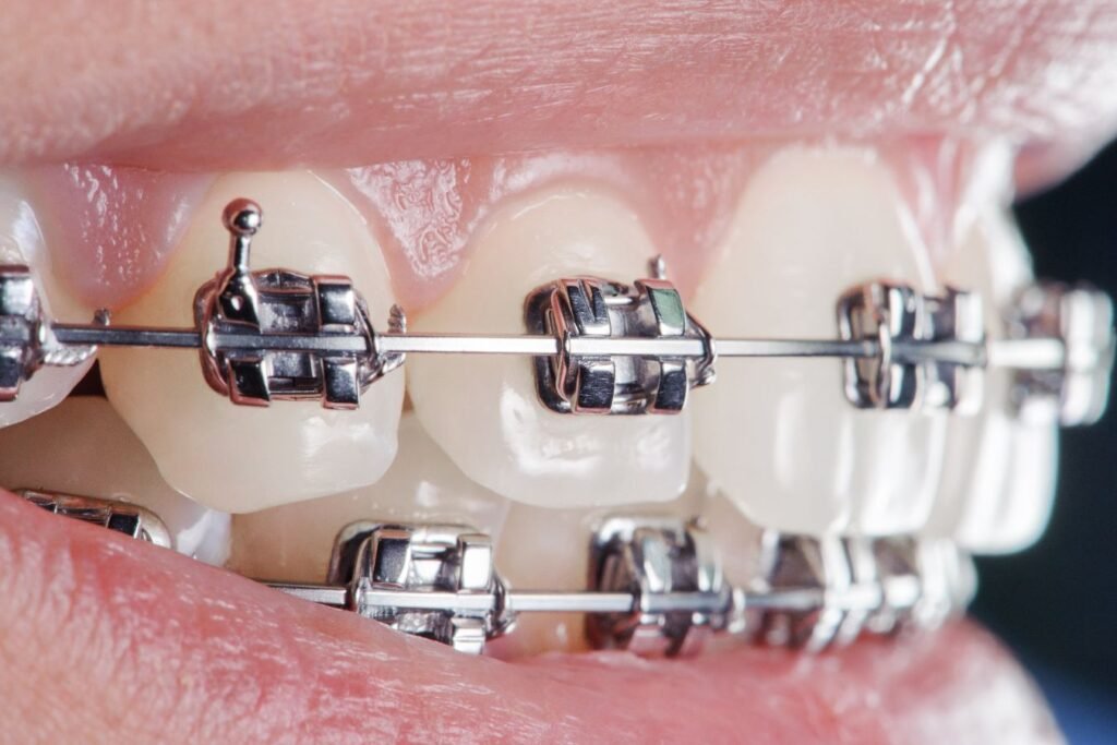 ortodoncia-brackets-metalicos-tradicionales-en-cunit-02