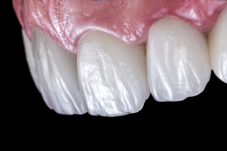 carillas-de-porcelana-ceramica-en-cunit