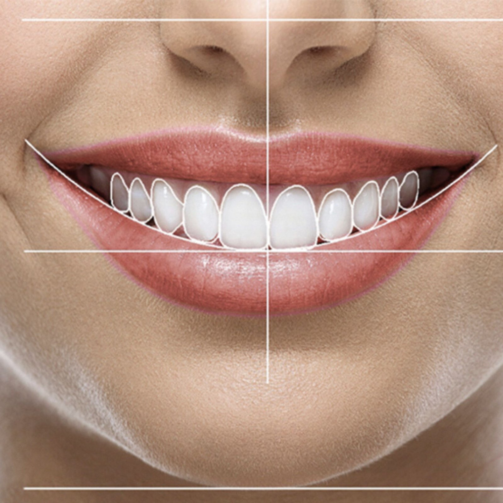 diseño-digital-de-sonrisa-en-cunit
